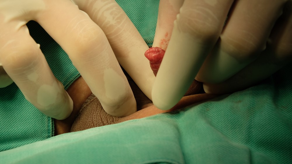 Phimosis in Boys